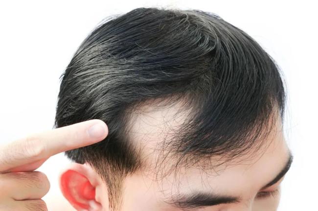 雍禾医疗,种得青丝难解愁(图1) 雍禾医疗,种得青丝难解愁(图1)